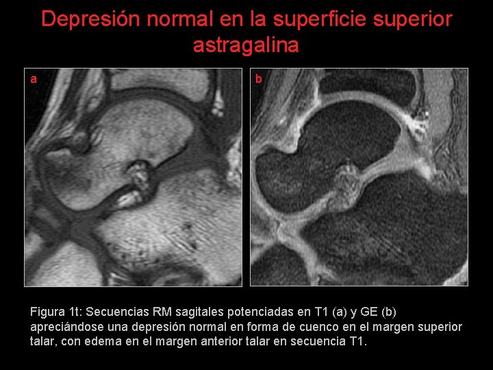 Depresión normal en la superficie superior astragalina a b Figura 1 t: Secuencias RM