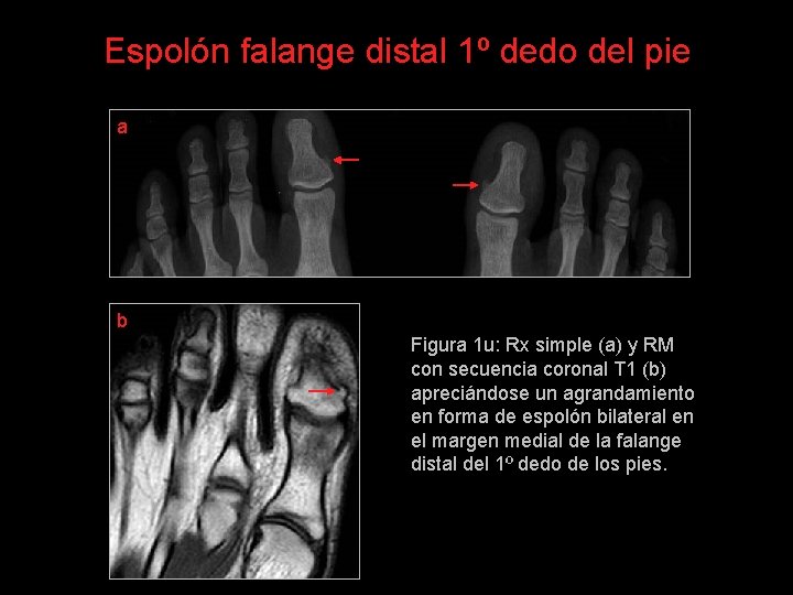 Espolón falange distal 1º dedo del pie a b Figura 1 u: Rx simple