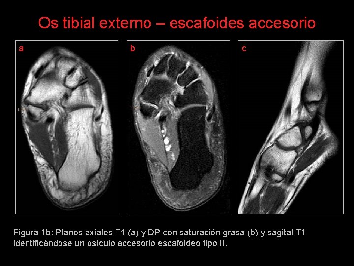 Os tibial externo – escafoides accesorio a b c Figura 1 b: Planos axiales