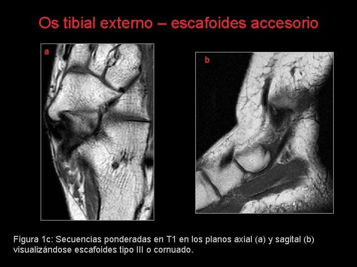 Os tibial externo – escafoides accesorio a b Figura 1 c: Secuencias ponderadas en