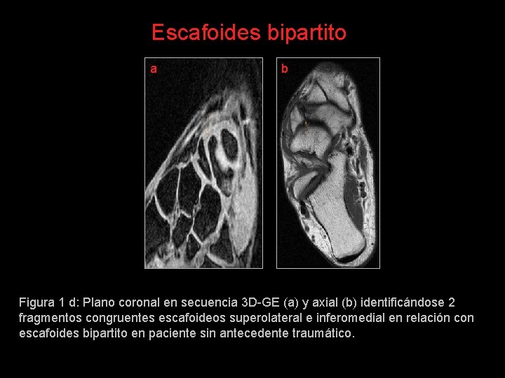 Escafoides bipartito a b Figura 1 d: Plano coronal en secuencia 3 D-GE (a)