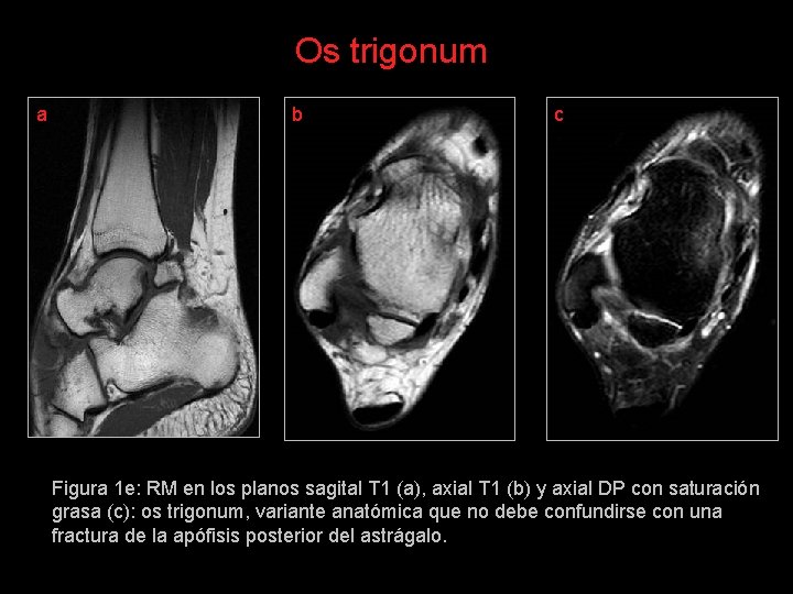 Os trigonum a b c Figura 1 e: RM en los planos sagital T