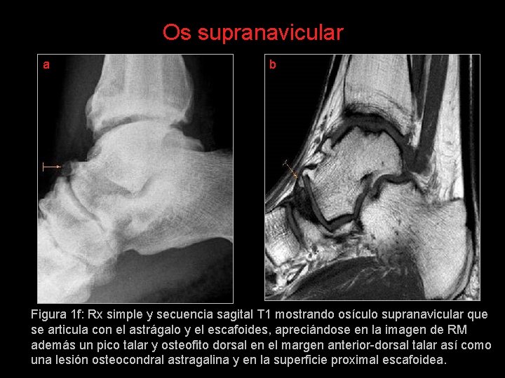 Os supranavicular a b Figura 1 f: Rx simple y secuencia sagital T 1