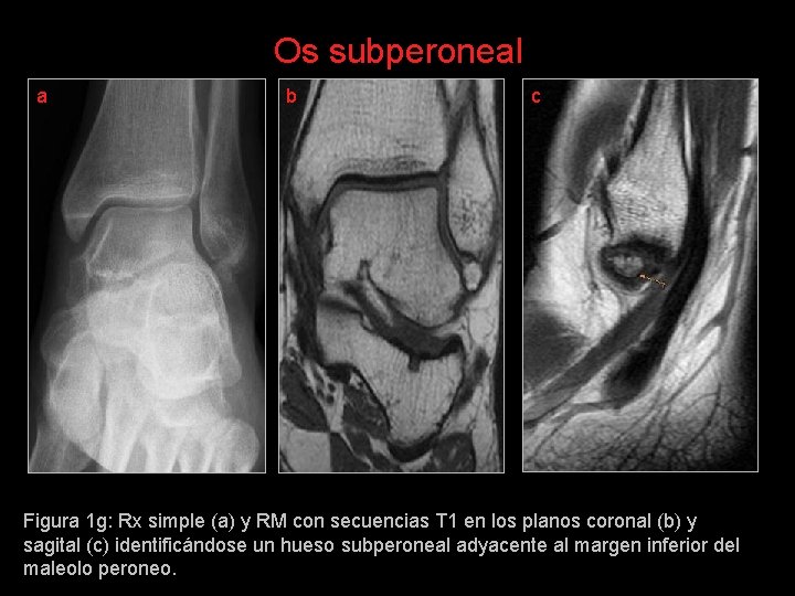 Os subperoneal a b c Figura 1 g: Rx simple (a) y RM con