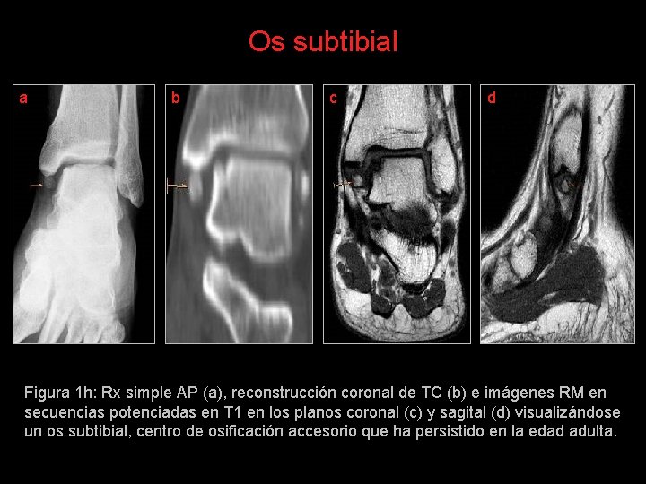 Os subtibial a b c d Figura 1 h: Rx simple AP (a), reconstrucción