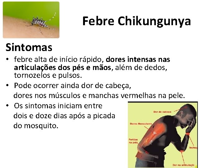 Febre Chikungunya Sintomas • febre alta de início rápido, dores intensas nas articulações dos