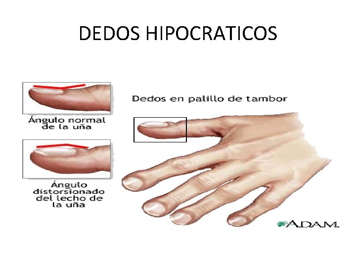 DEDOS HIPOCRATICOS 