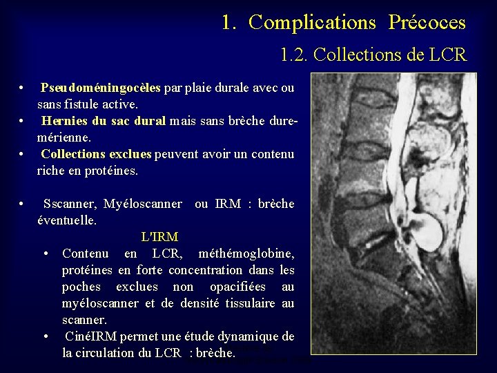 1. Complications Précoces 1. 2. Collections de LCR • Pseudoméningocèles par plaie durale avec