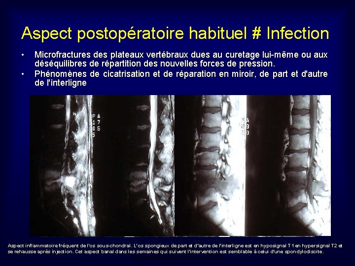 Aspect postopératoire habituel # Infection • • Microfractures des plateaux vertébraux dues au curetage