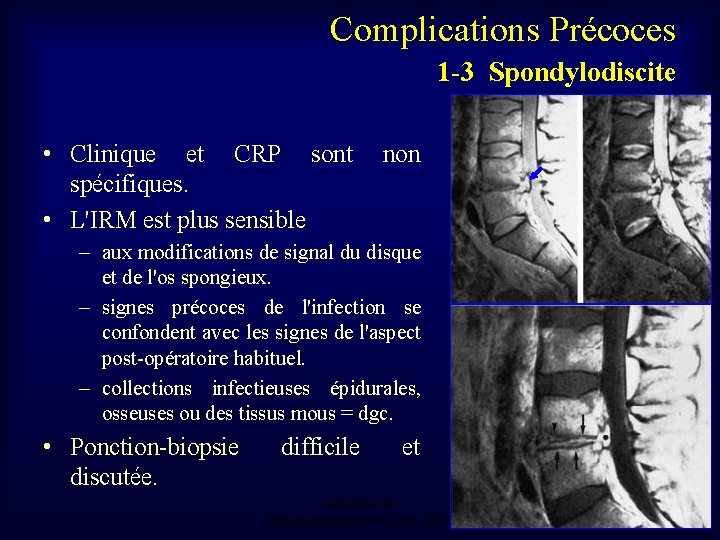 Complications Précoces 1 -3 Spondylodiscite • Clinique et CRP sont spécifiques. • L'IRM est