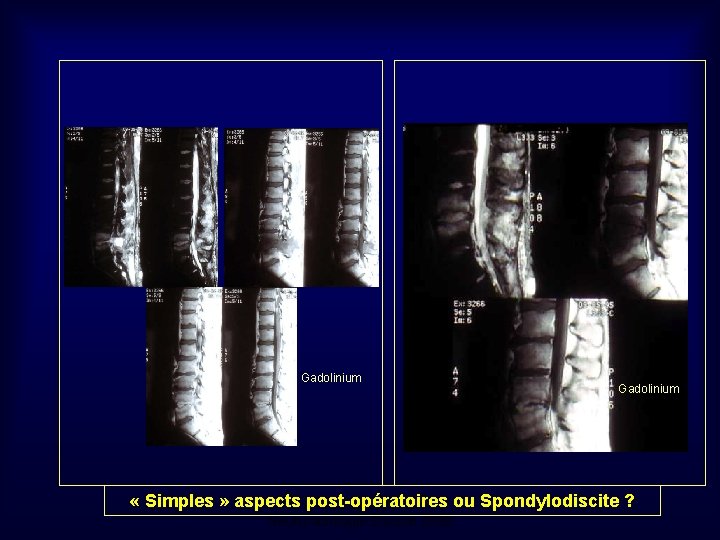 Gadolinium « Simples » aspects post-opératoires ou Spondylodiscite ? Mastère de Neuroradiologie. Sousse 2008