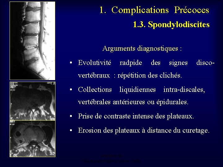 1. Complications Précoces 1. 3. Spondylodiscites Arguments diagnostiques : • Evolutivité radpide des signes