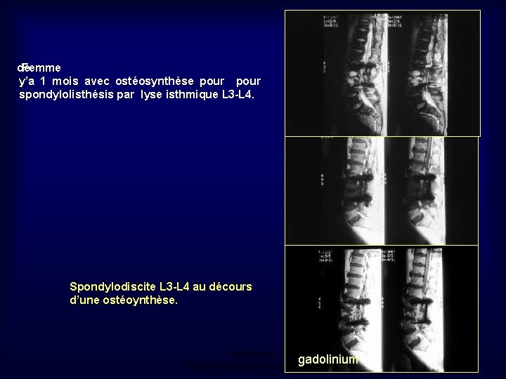 de Femme y’a 1 mois avec ostéosynthèse pour spondylolisthésis par lyse isthmique L 3