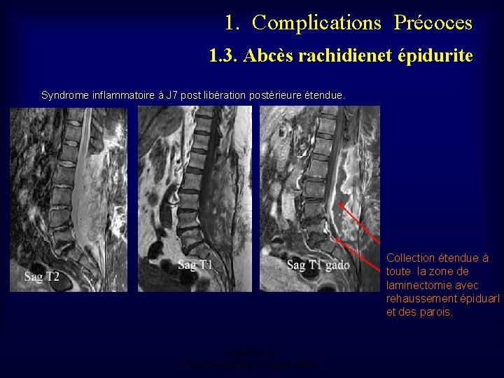 1. Complications Précoces 1. 3. Abcès rachidienet épidurite Syndrome inflammatoire à J 7 post