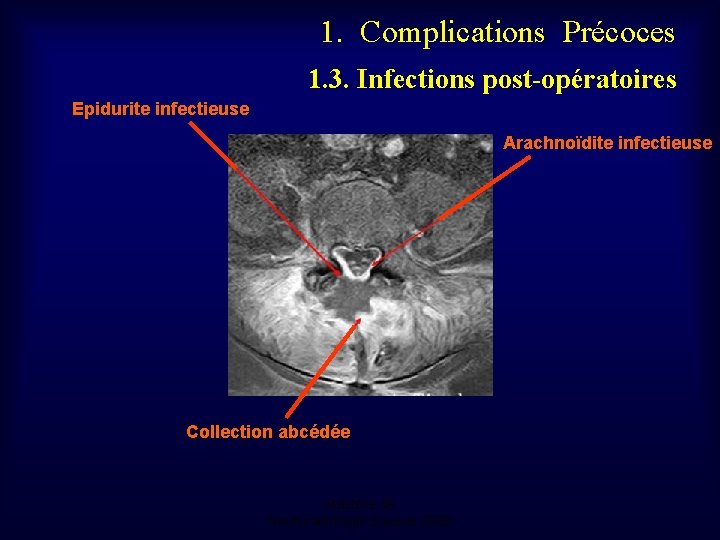 1. Complications Précoces 1. 3. Infections post-opératoires Epidurite infectieuse Arachnoïdite infectieuse Collection abcédée Mastère