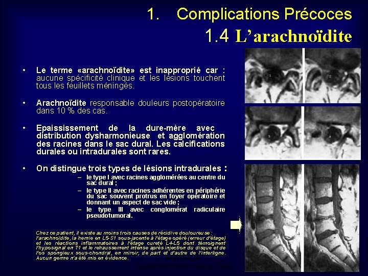 1. Complications Précoces 1. 4 L’arachnoïdite • Le terme «arachnoïdite» est inapproprié car :