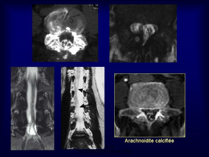 Arachnoidite calcifiée Mastère de Neuroradiologie. Sousse 2008 