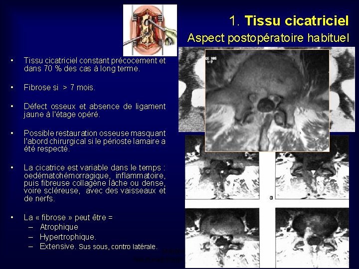 1. Tissu cicatriciel Aspect postopératoire habituel • Tissu cicatriciel constant précocement et dans 70