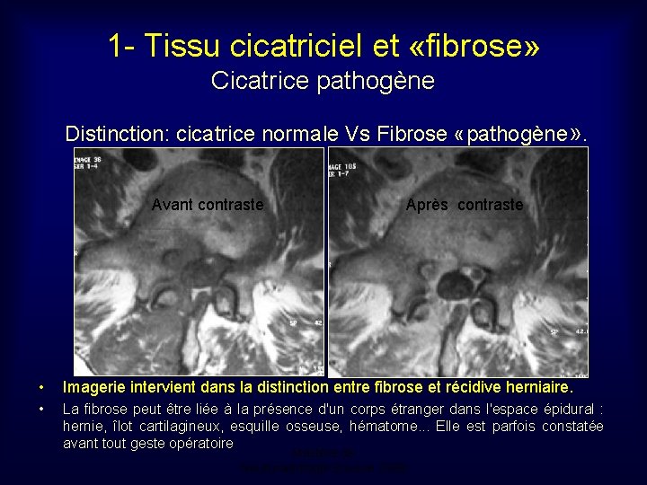 1 - Tissu cicatriciel et «fibrose» Cicatrice pathogène Distinction: cicatrice normale Vs Fibrose «pathogène»