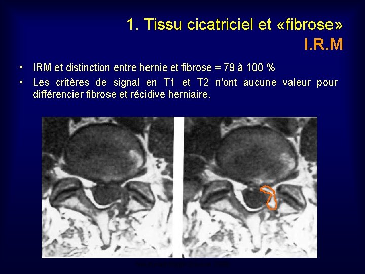 1. Tissu cicatriciel et «fibrose» I. R. M • IRM et distinction entre hernie