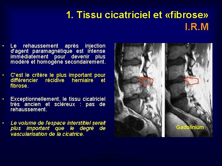 1. Tissu cicatriciel et «fibrose» I. R. M • Le rehaussement après injection d'agent