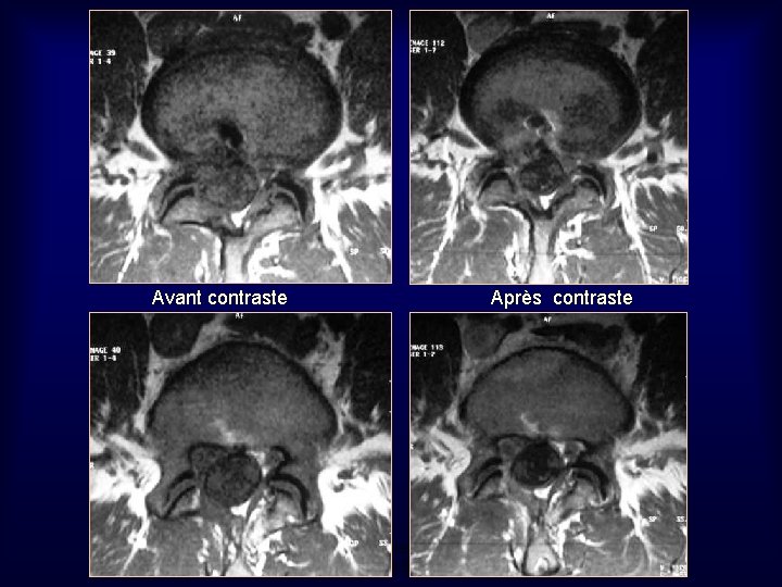 Avant contraste Après contraste Mastère de Neuroradiologie. Sousse 2008 