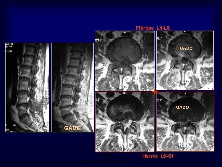 Fibrose L 4 -L 5 GADO + GADO Mastère de Hernie L 5 -S