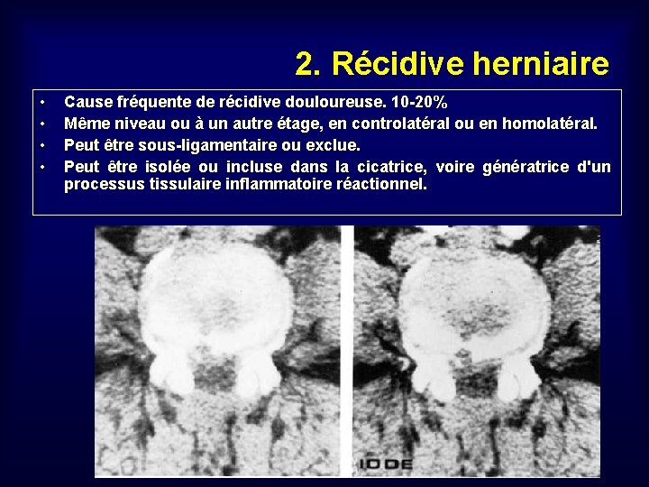 2. Récidive herniaire • • Cause fréquente de récidive douloureuse. 10 -20% Même niveau
