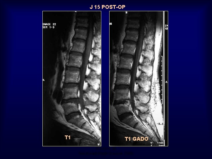 J 15 POST-OP T 1 GADO Mastère de Neuroradiologie. Sousse 2008 