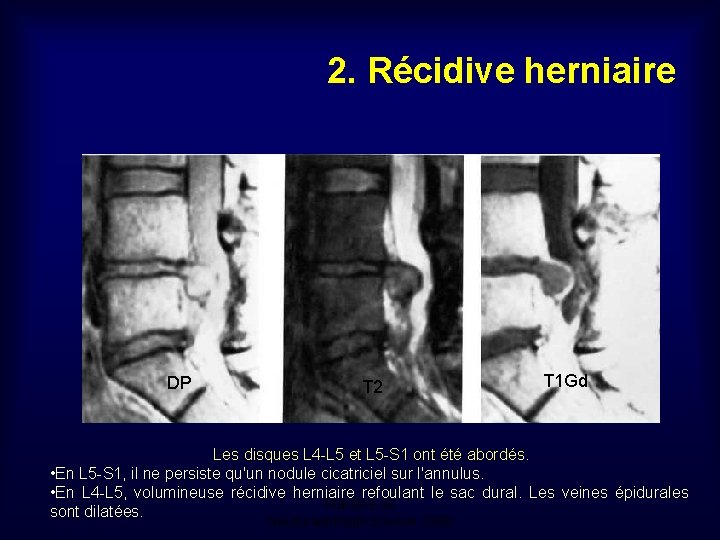 2. Récidive herniaire DP T 2 T 1 Gd Les disques L 4 -L