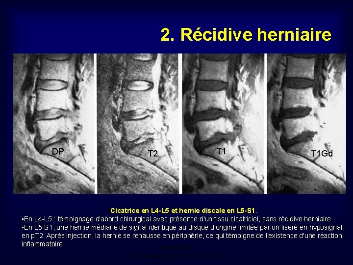 2. Récidive herniaire DP T 2 T 1 Gd Cicatrice en L 4 -L