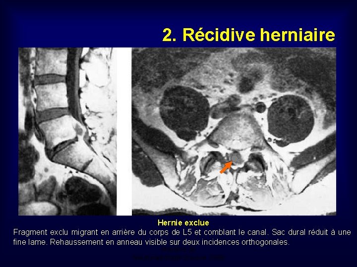2. Récidive herniaire Hernie exclue Fragment exclu migrant en arrière du corps de L