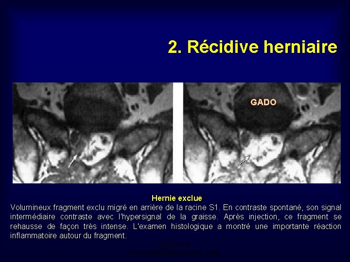 2. Récidive herniaire GADO Hernie exclue Volumineux fragment exclu migré en arrière de la