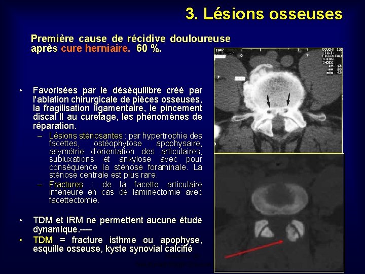 3. Lésions osseuses Première cause de récidive douloureuse après cure herniaire. 60 %. •