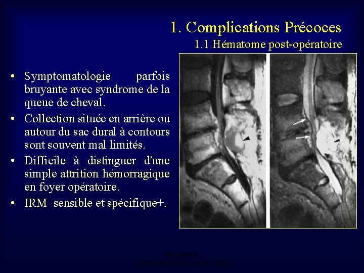 1. Complications Précoces 1. 1 Hématome post-opératoire • Symptomatologie parfois bruyante avec syndrome de