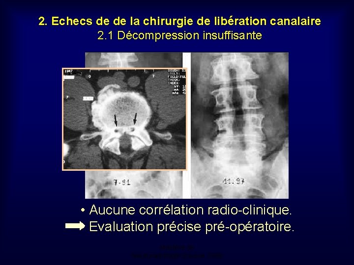 2. Echecs de de la chirurgie de libération canalaire 2. 1 Décompression insuffisante •