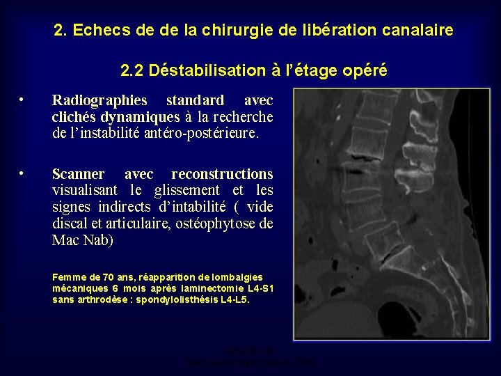 2. Echecs de de la chirurgie de libération canalaire 2. 2 Déstabilisation à l’étage