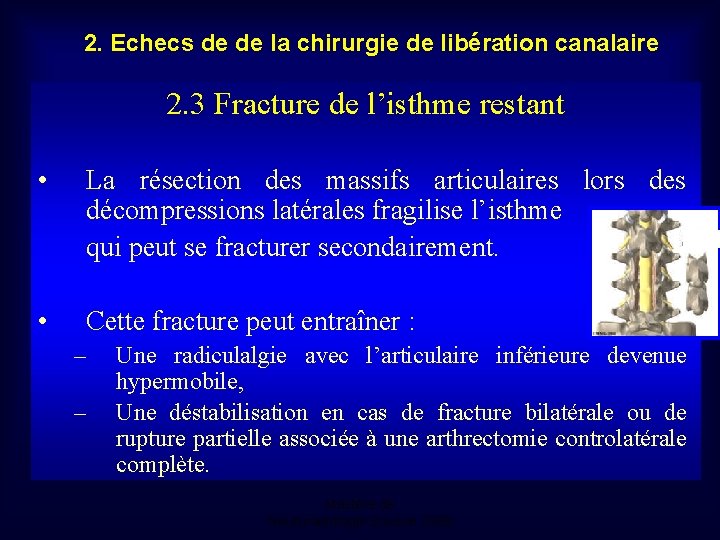 2. Echecs de de la chirurgie de libération canalaire 2. 3 Fracture de l’isthme