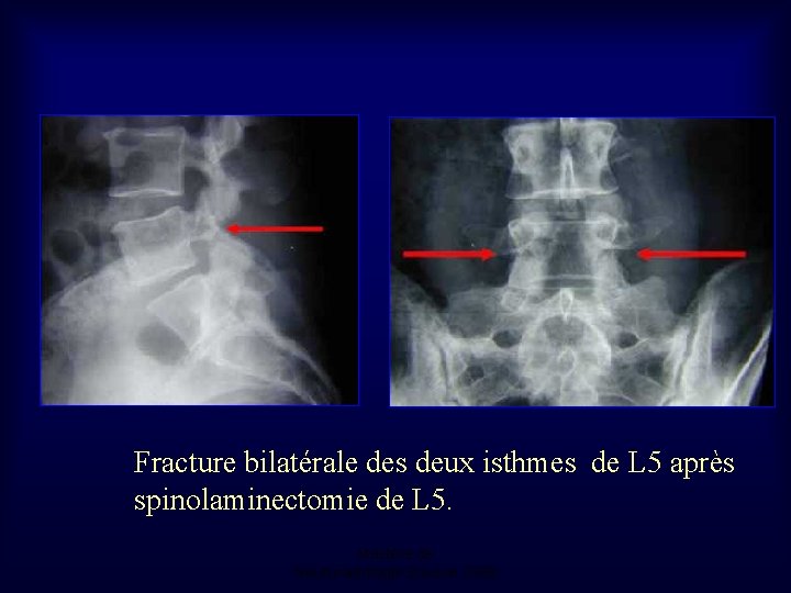 Fracture bilatérale des deux isthmes de L 5 après spinolaminectomie de L 5. Mastère