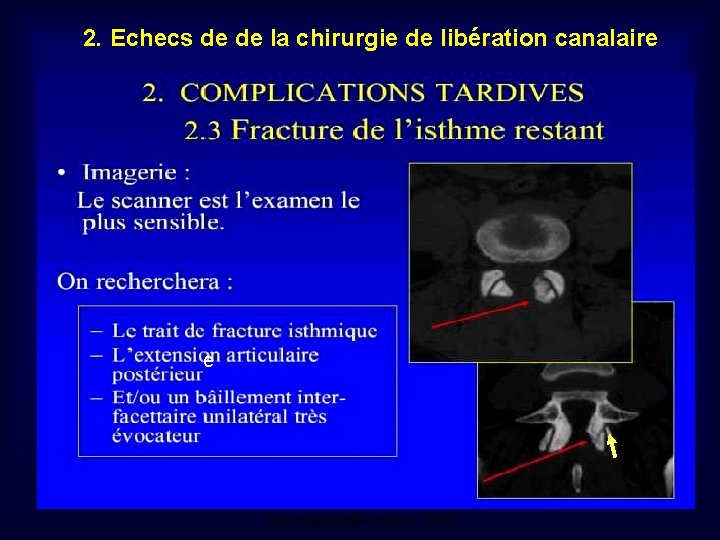 2. Echecs de de la chirurgie de libération canalaire e Mastère de Neuroradiologie. Sousse