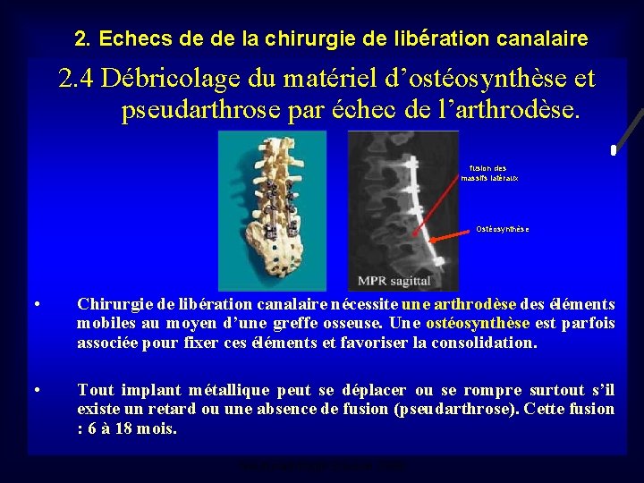2. Echecs de de la chirurgie de libération canalaire 2. 4 Débricolage du matériel