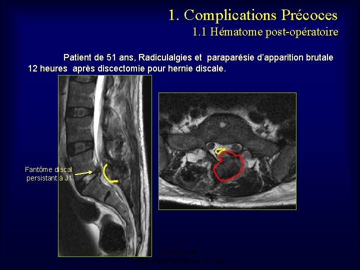 1. Complications Précoces 1. 1 Hématome post-opératoire Patient de 51 ans, Radiculalgies et paraparésie