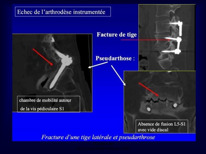 Mastère de Neuroradiologie. Sousse 2008 