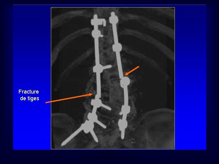 Fracture de tiges Mastère de Neuroradiologie. Sousse 2008 