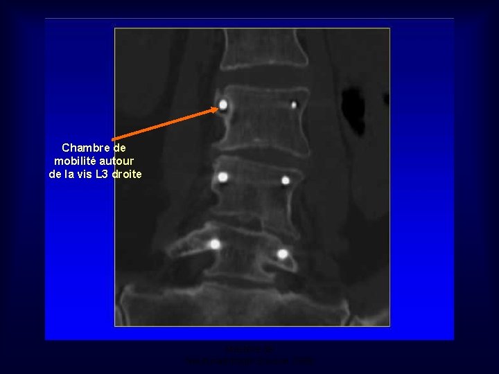 Chambre de mobilité autour de la vis L 3 droite Mastère de Neuroradiologie. Sousse