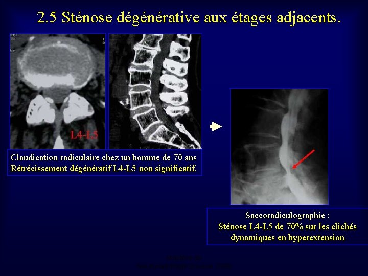 2. 5 Sténose dégénérative aux étages adjacents. Claudication radiculaire chez un homme de 70