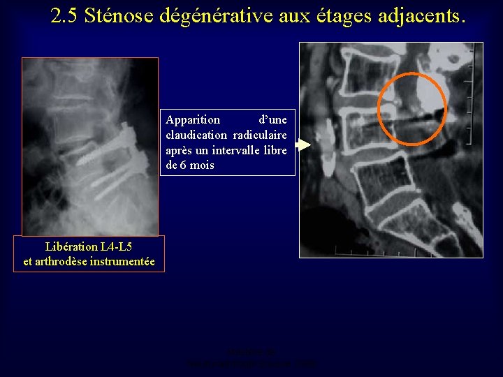 2. 5 Sténose dégénérative aux étages adjacents. Apparition d’une claudication radiculaire après un intervalle