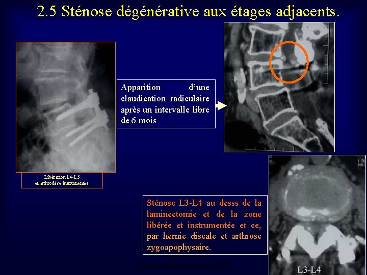 2. 5 Sténose dégénérative aux étages adjacents. Apparition d’une claudication radiculaire après un intervalle