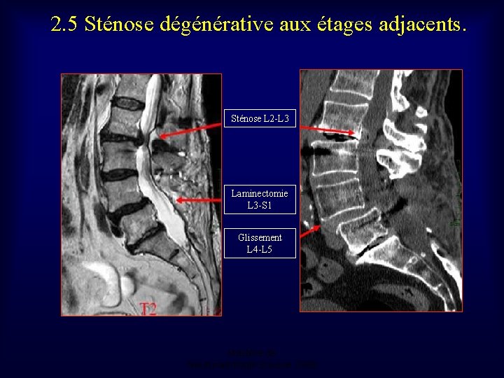 2. 5 Sténose dégénérative aux étages adjacents. Sténose L 2 -L 3 Laminectomie L