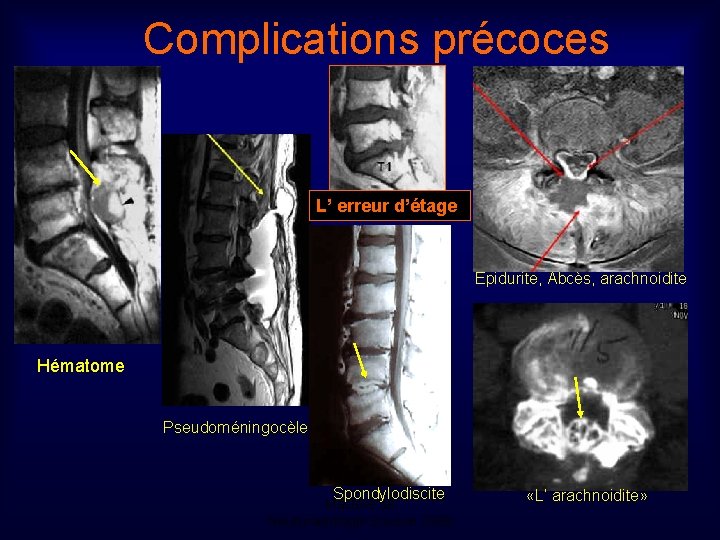 Complications précoces L’ erreur d’étage Epidurite, Abcès, arachnoidite Hématome Pseudoméningocèle Spondylodiscite Mastère de Neuroradiologie.